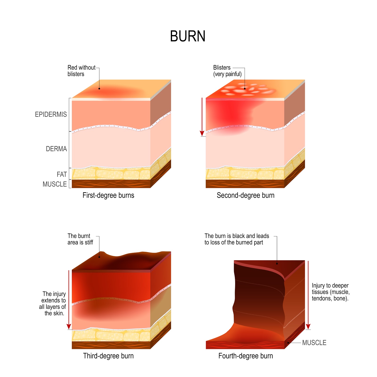 Burn Injury Severity Levels